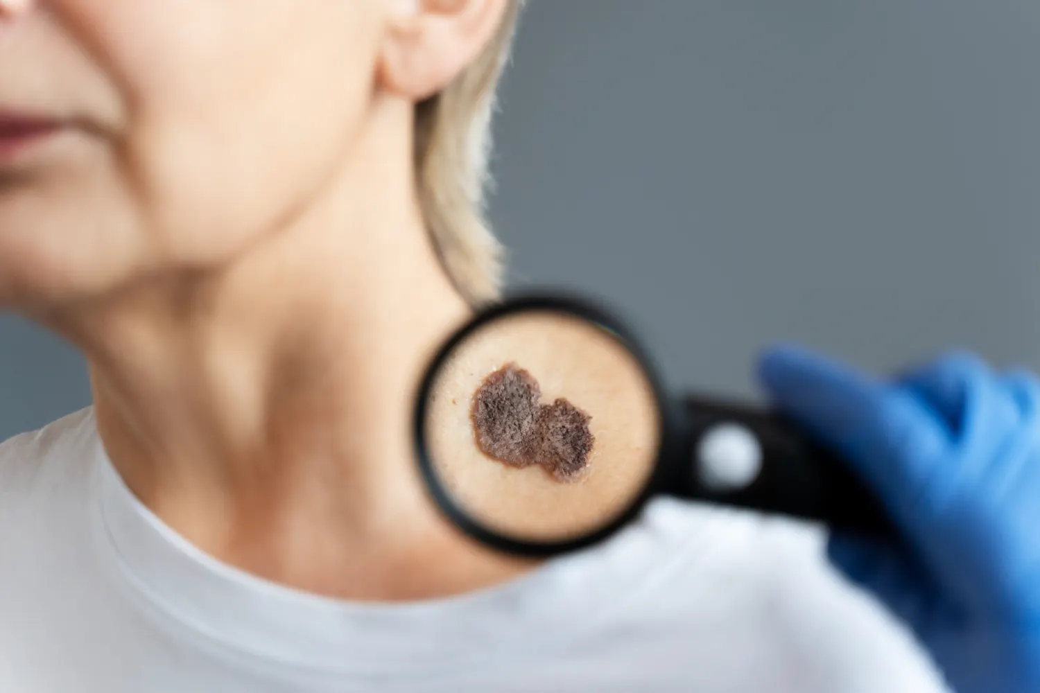 Maestría en Complicaciones Cutáneas por Estética Necrosis Granulomas e Infecciones Maestría en Complicaciones Cutáneas por Estética Necrosis Granulomas e Infecciones 1