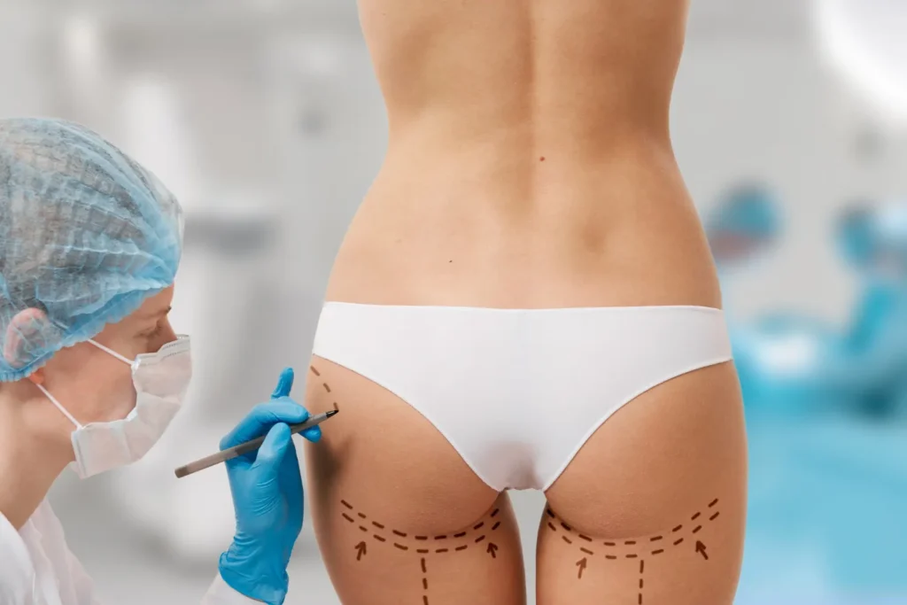 Maestría en Lipotransferencia y Gluteoplastia 2