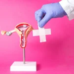 Maestría endometriosis 1